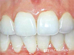 Dental Implants Dentist in Clifton NJ