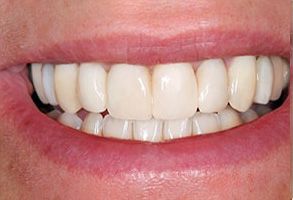 New Smile Dentistry | Oral Cancer Screening, Implant Dentistry and Periodontal Treatment