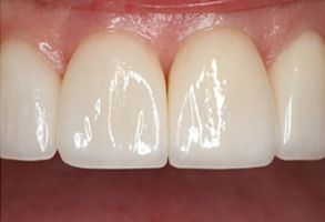 New Smile Dentistry | Dental Bridges, Icon White and Digital Radiography